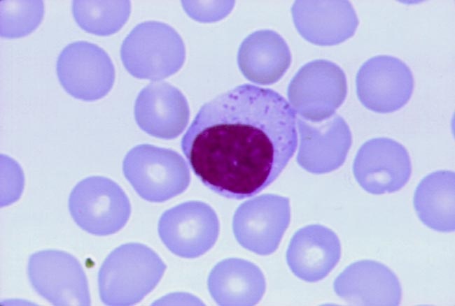 hairy cell leukemia case study Unusual presentation of hairy cell leukemia: a case series of four clinically unsuspected cases this is an observational study conducted between january. hairy cell leukemia case study Unusual presentation of hairy cell leukemia: a case series of four clinically unsuspected cases this is an observational study conducted between january.