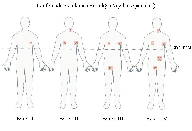 Lenfoma Kanseri