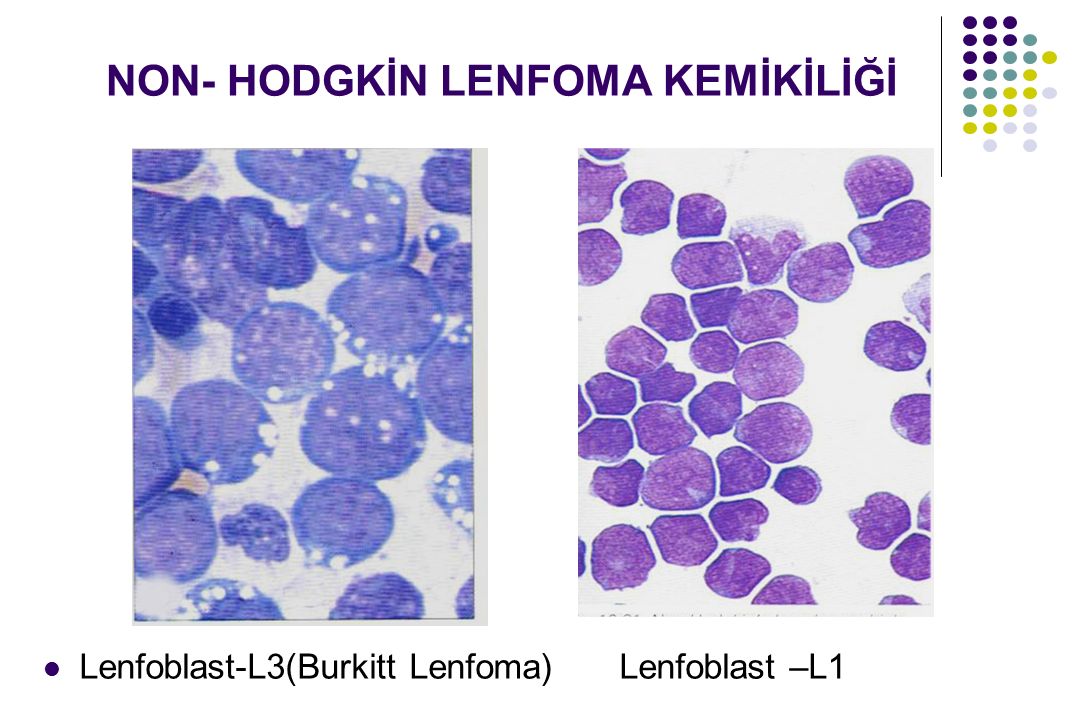 Non Hodgkin Lenfoma 4. Evre